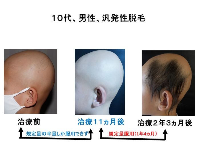 円形脱毛症　病院